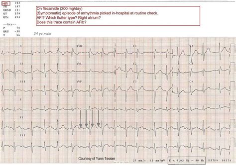 ECG Teaching Series: Atrial Flutter | ECG Guru - Instructor Resources