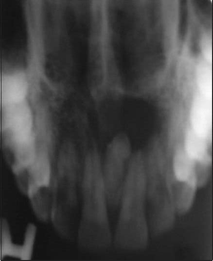 Maxillary Occlusal Radiograph Showing Well Defined Corticated Download Scientific Diagram