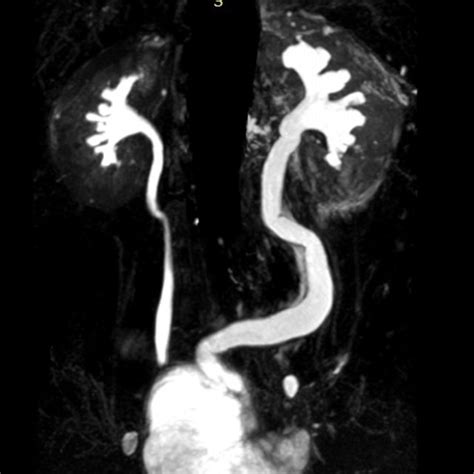 A 54 Years Old Male With Urinary Bladder Cancer Invasive Tcc Grade