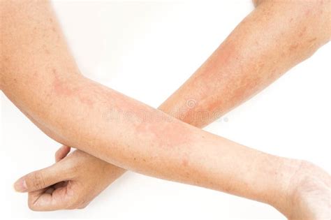 Skin Rashes Allergies