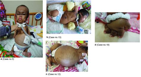 Dermatological findings of acanthosis nigricans. Individuals with... | Download Scientific Diagram