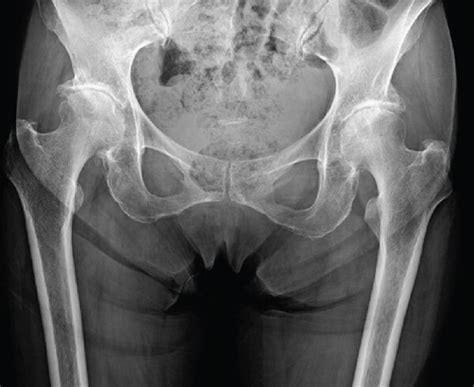 Bilateral Greater Trochanteric Avulsion Fractures After Bilateral