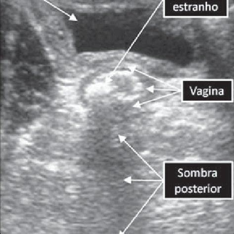 Ultrasonography Demonstrating A Vaginal Foreign Body A Hyperechogenic