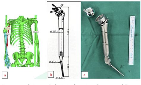 Figure 1 from Total humerus replacement with reverse shoulder design for non-oncologic ...