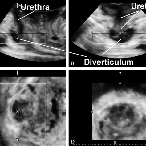 —standard Acquisition Screen Of 3d Pelvic Floor Ultrasound When Using