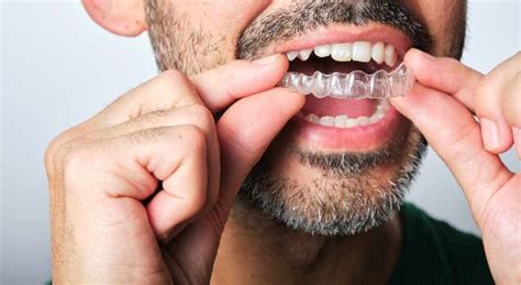 Tips To Speed Up The Invisalign Treatment Process