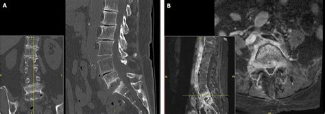 Lumbar Osteomyelitis And Discitis Clinical Tree