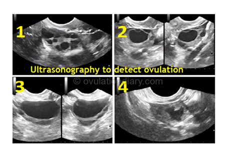 Ultrasound scanning of ovulation - Folliculometry (+ Photo!) - OvulationDiary.com