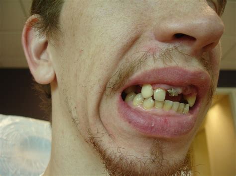 Nerve Exposed Nerve In Tooth