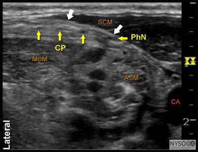 Ultrasound-Guided Superficial Cervical Plexus Block - NYSORA The New ...