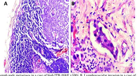 Figure From Tumor Budding In Invasive Carcinoma Of Breast Of No