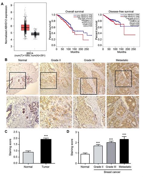 ABHD12 Knockdown Suppresses Breast Cancer Cell Proliferation Migration