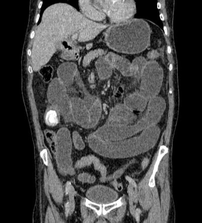 Cholecystoduodenal Fistula Radiology Reference Article Radiopaedia Org