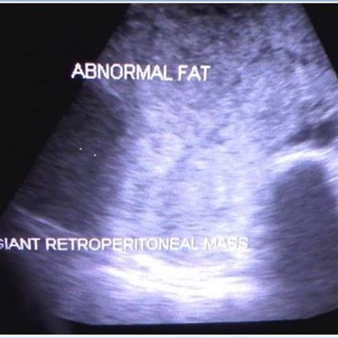 Ultrasonography Of Abdomen Shows Large Diffusely Echogenic Mass Fat