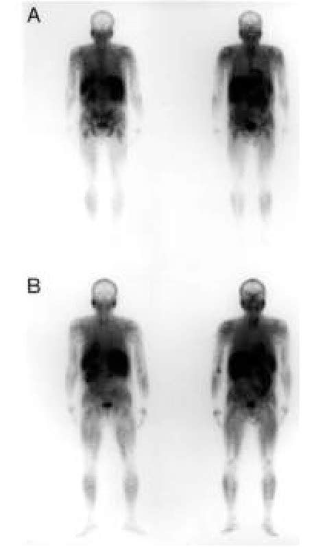 Posterior Left And Anterior Right Whole Body Scintigraphy Acquired