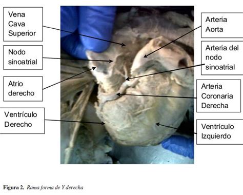 Variaciones De La Arteria Del Nodo Sinoatrial En Poblaci N Colombiana