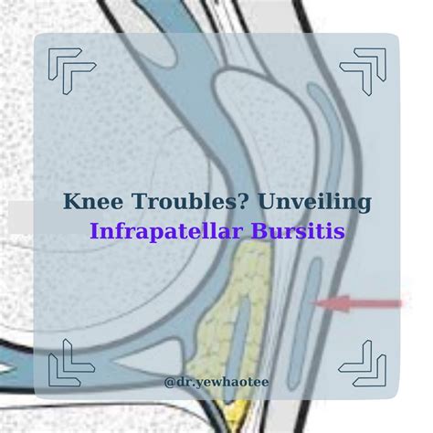 How to prevent infrapatellar bursitis | Dr. Yew Hao TEE 鄭猷豪脊醫 posted on ...