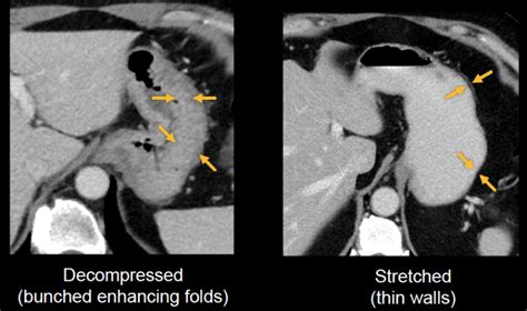 Abdominal Ct Oesophagus And Stomach • Litfl • Radiology