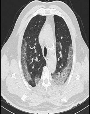 HRCT Chest Showing Bilateral Patchy Confluent Ground Glass Opacities