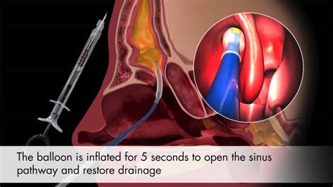 Balloon Sinuplasty Animation And Patient Testimonials Houston Sinus