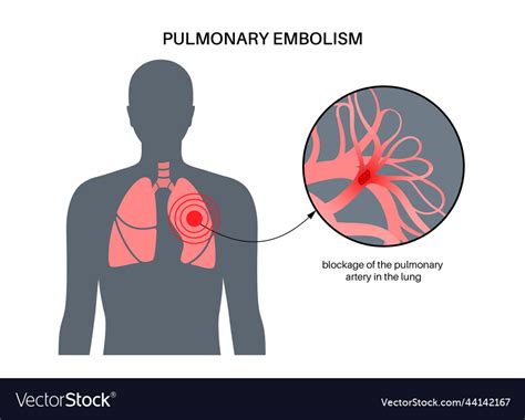 Pulmonary Embolism Disease Royalty Free Vector Image