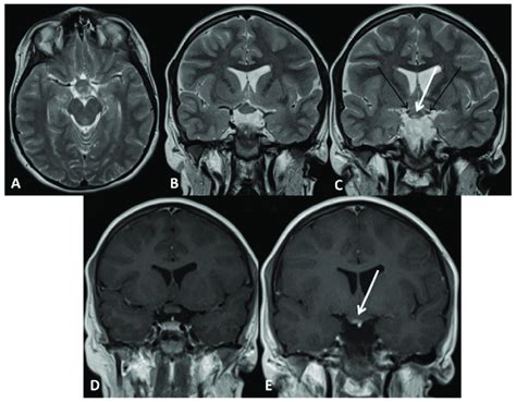 Optic glioma 1Aright (Subject 12 OPG). Orbit MRI. (A) Axial T2-weighted... | Download Scientific ...