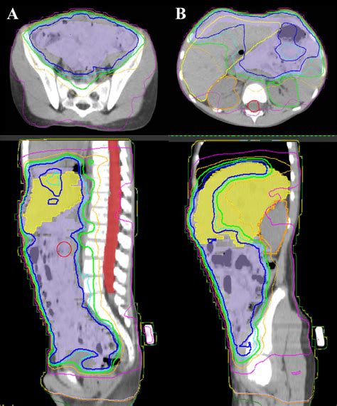 Whole Abdominopelvic Intensity Modulated Radiation Therapy Plans For Download Scientific