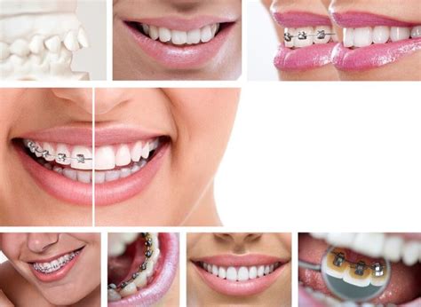 Jordan Orthodontist A Brief History Of Braces Dansie Orthodontics