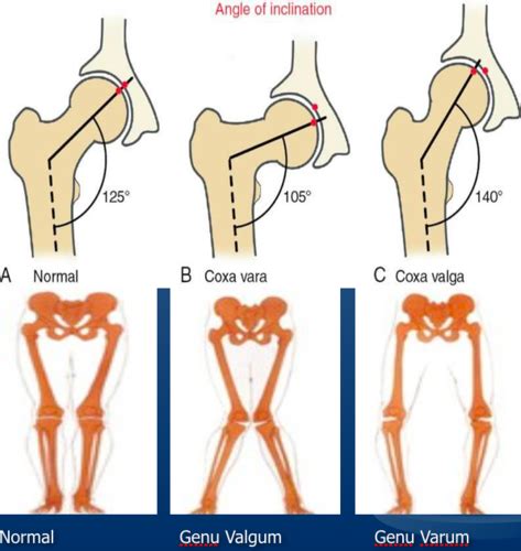 Coxa Valga Genu Varum