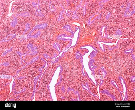 Inflamed Fallopian Tube Light Micrograph Of A Section Through A