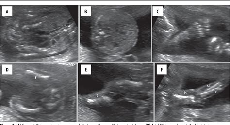 Figure 2 From Antenatal Diagnosis Of Jeune Syndrome Asphyxiating