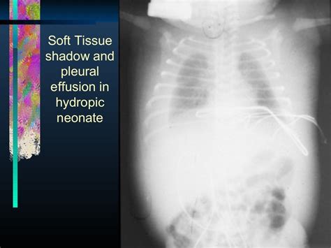 Managing Nonimmune Hydrops Fetalis