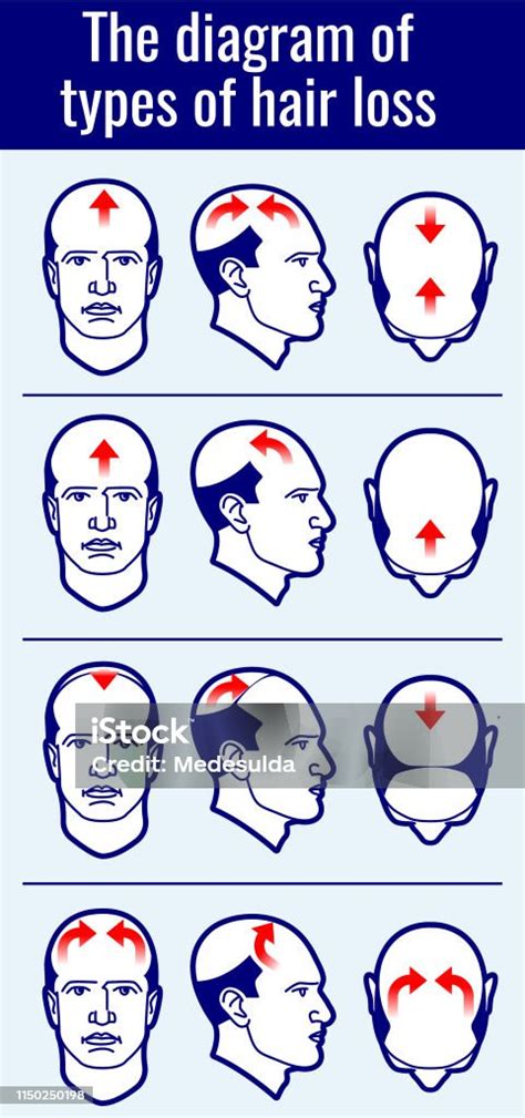 Hair Loss Types Stock Illustration - Download Image Now - Adult, Aging Process, Anatomy - iStock