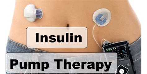 Insulin Pump Cause Weight Gain | Blog Dandk