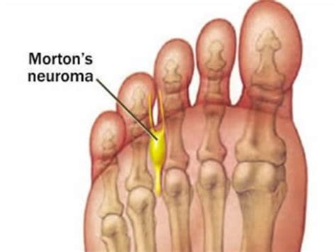 Mortons Neuroma Metatarsalgia Podiatry Quest