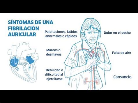 Fibrilacion Auricular Sintomas Youtube