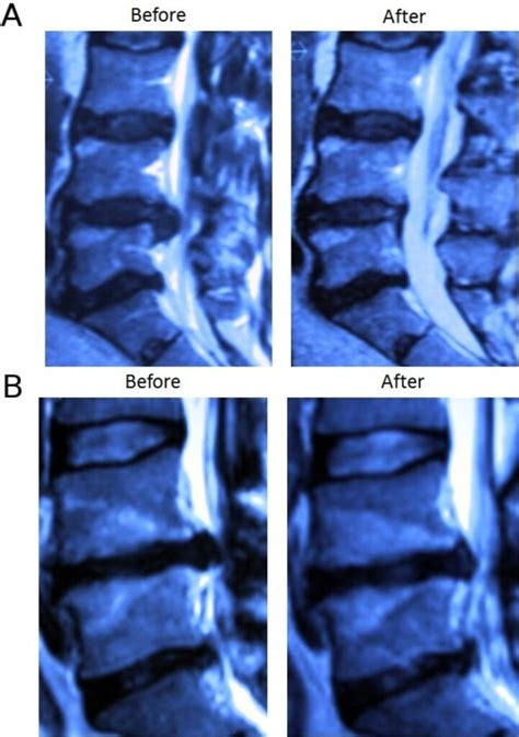 Ozonoterapia En Hernia Discal Disc Lisis Con Ozono