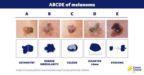 Moles — Dermatology Specialists Of Kansas City