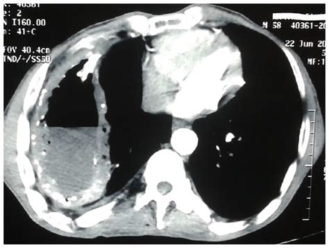 Open Window Thoracostomy For A Chronic Calcified Pleural Empyema In The