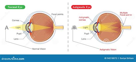 Vision of Normal Eye and Astigmatic Stock Vector - Illustration of ...