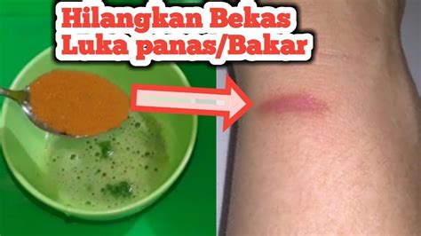 Cara Menghilangkan Bekas Luka Setrika Secara Alami Menghilangkan Masalah