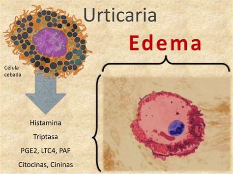 Diferencias Entre Dermatitis Atópica Y Urticaria Prof Ortega Martell