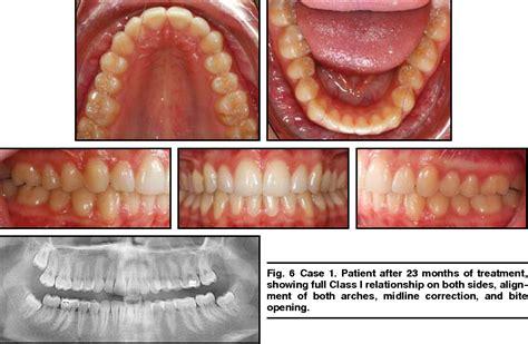 Figure 1 From Class II Correction With The Invisalign System