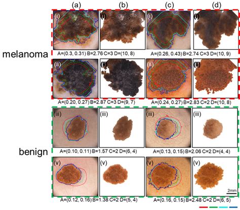 The segmentation stage identifies the lesion from the background using... | Download Scientific ...