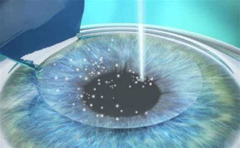 Femto Lasik Laser Eye Surgery Malaysia Ikonik Eye Centre