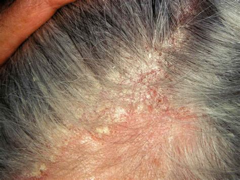 Seborrheic Dermatitis According To The Nhs Causes And Treatments