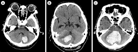 The Degree Of Compression Of The 4th Ventricle On Ct Scans