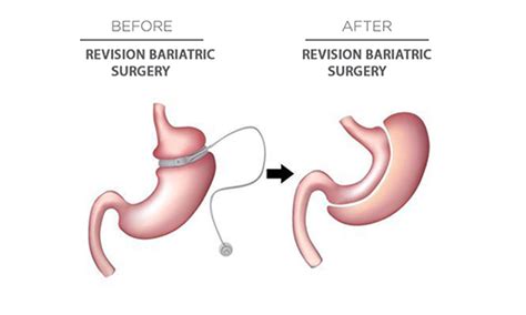 Revision Bariatric Surgery - Dr. Mahidhar Valeti