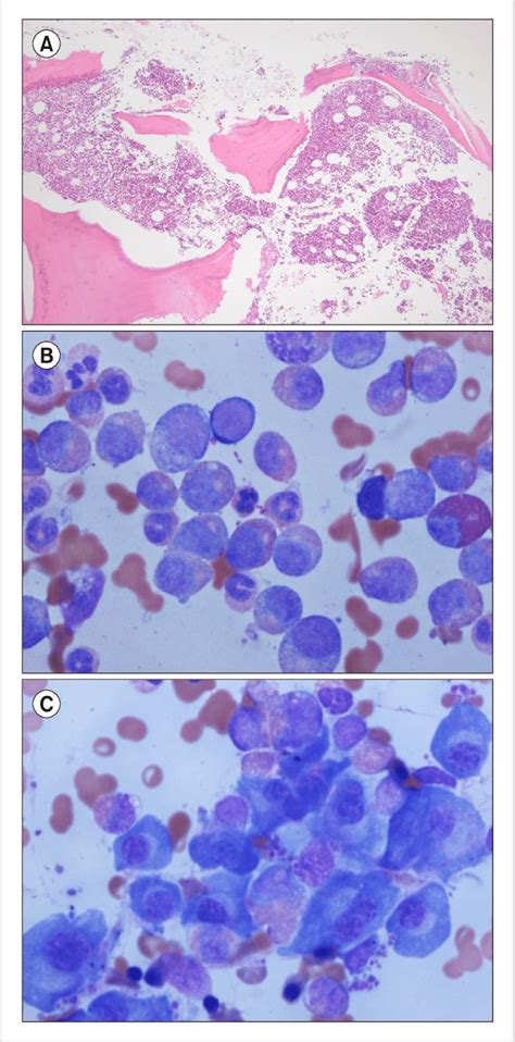 Bone Marrow Biopsy And Aspiration At Diagnosis A Bone Marrow Biopsy Download Scientific