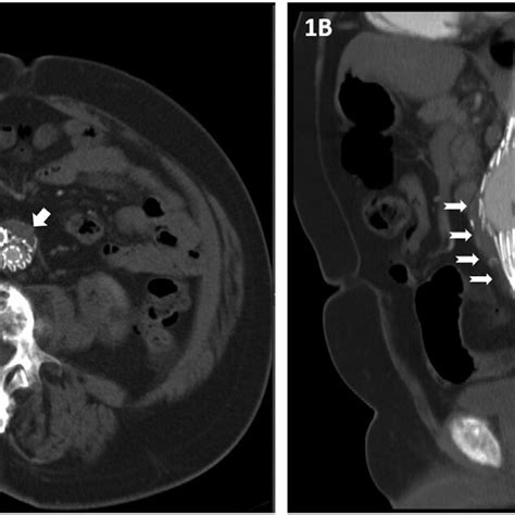 Computed Tomography Angiography Cta Performed 6 Months After